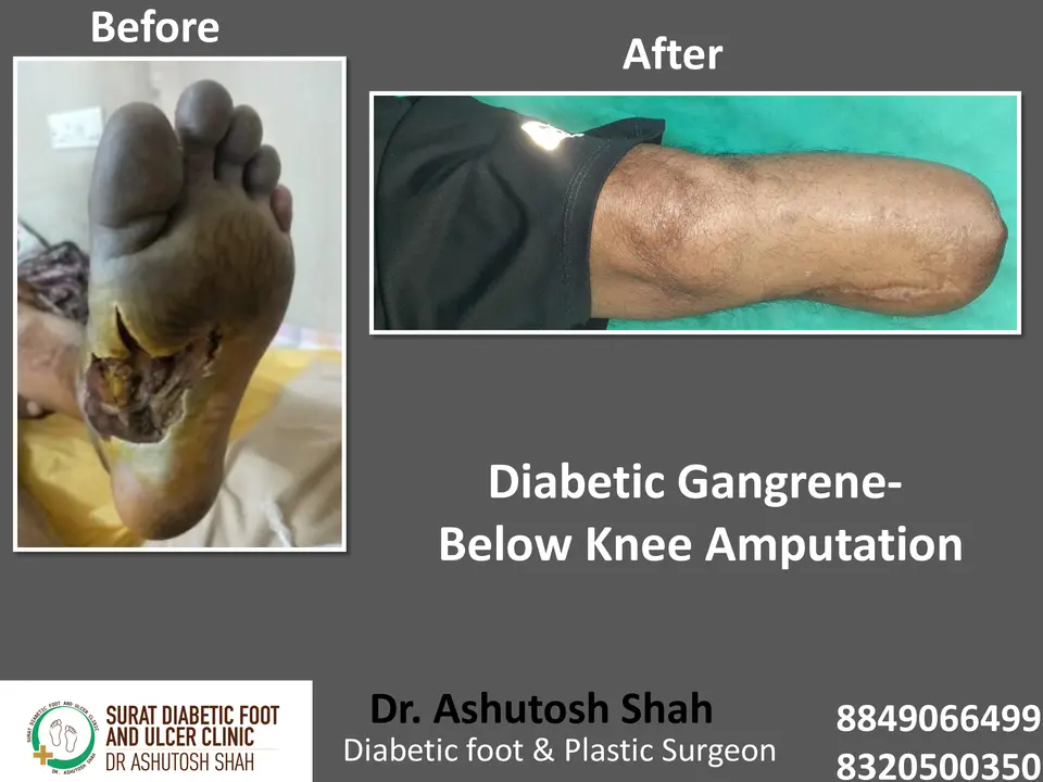 Diabetic Foot  PPT sunita.pptx-15.webp